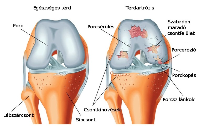 a térd artrózisának korlátozásai